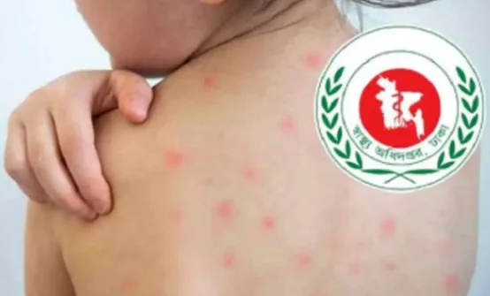 হামের উপসর্গে আরও পাঁচ শিশুর মৃত্যু, এক দিনে নতুন রোগী মোট ১২১০ জন