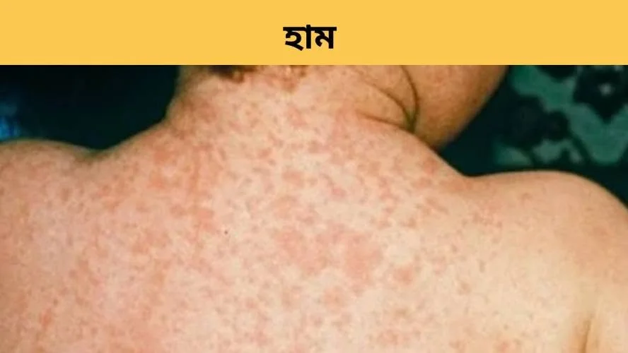 হামের প্রাদুর্ভাবে নতুন উদ্বেগ, টিকার ঘাটতিতে বাড়ছে ঝুঁকি