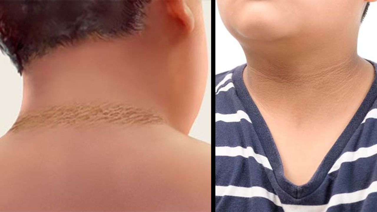 শিশুর শরীরের কালো দাগ কীসের ইঙ্গিত