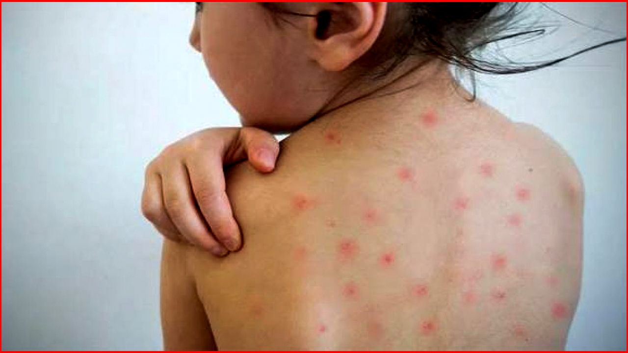 ফরিদপুরে হামের সংক্রমণ বাড়ছে ২৪ ঘণ্টায় নতুন ৩৯ আক্রান্ত