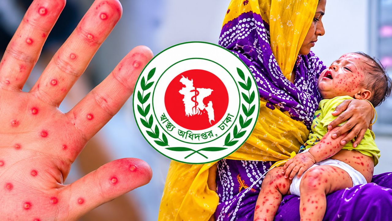 দেশে হামের পরিস্থিতি ভয়াবহ, মৃতের সংখ্যা ৫০০ ছাড়াল