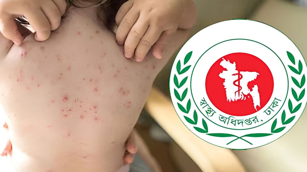 হাম পরিস্থিতি ভয়াবহ, সতর্কবার্তা স্বাস্থ্য অধিদপ্তরের